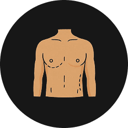 Gynecomastia