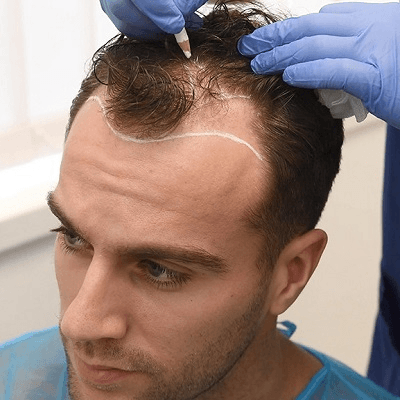 Natural Hair Transplant