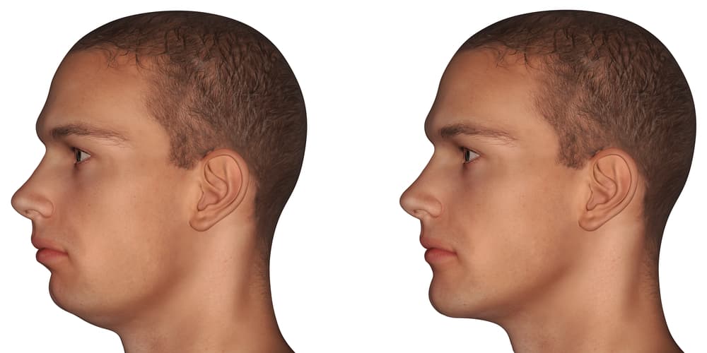 Chin Augmentation & Jawline Contouring in Hyderabad | Cost, Procedure & Results