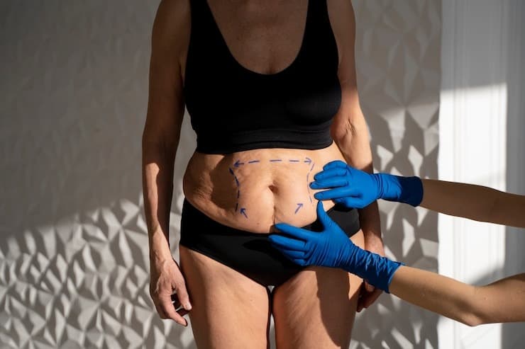 Laser Liposuction at Personiks: Hacks Only the Pros Know
