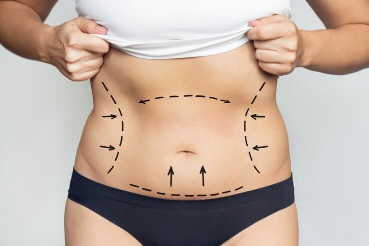 Achieve a Sculpted Physique with HD Liposuction at Personiks