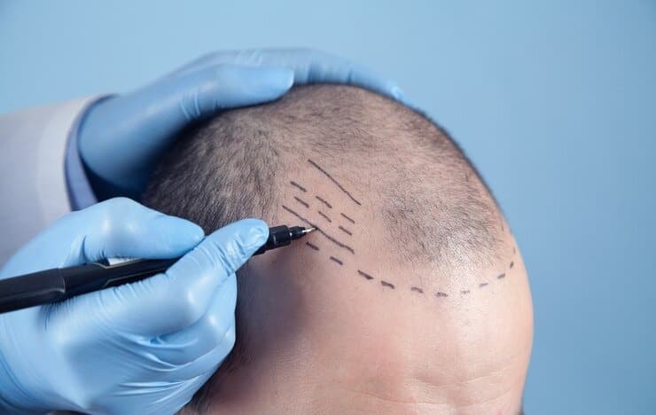 Hair Transplantation: What to Expect