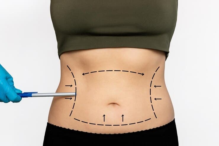 Laser Liposuction at Personiks: Achieve a Sculpted Body with Precision