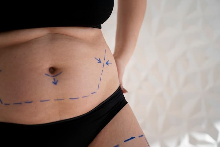 Non-Surgical Liposuction in Hyderabad: Transform Your Body at Personiks Hospital