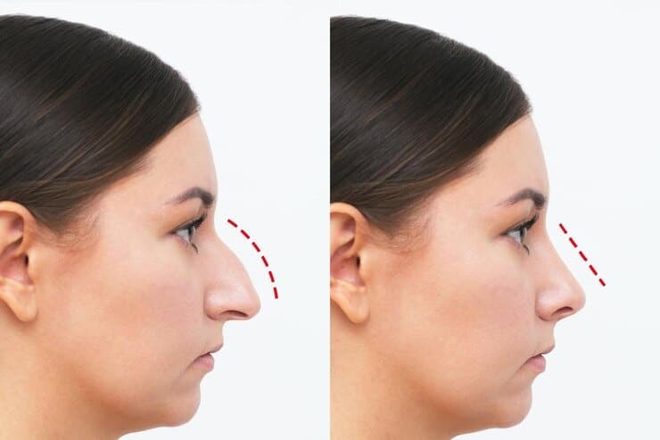 Nose Reshaping (Rhinoplasty) Surgery at Personiks Hyderabad
