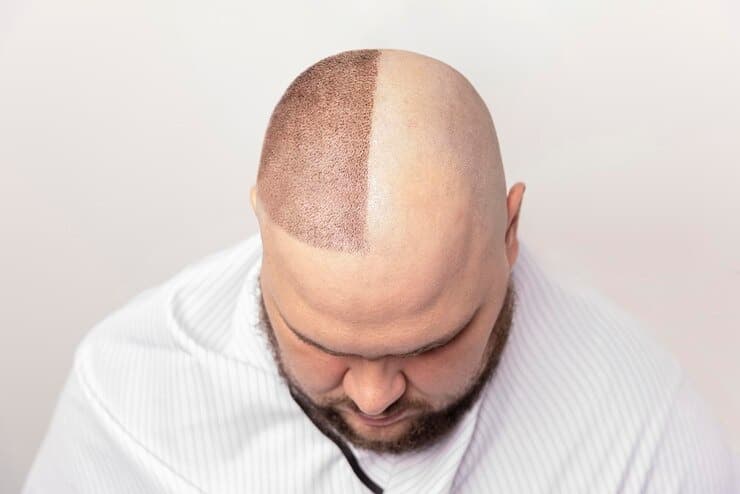 Restore Your Confidence with Advanced Hair Transplantation at Personiks Hospital