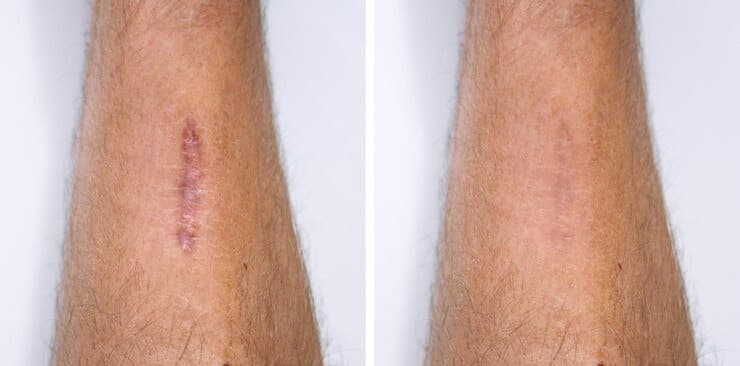 Scar Revision Treatment in Hyderabad - Personiks