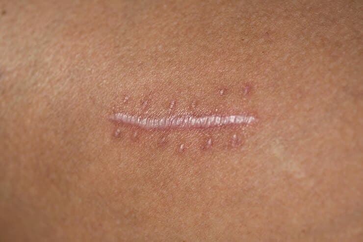 Understanding and Treating Burn Scars