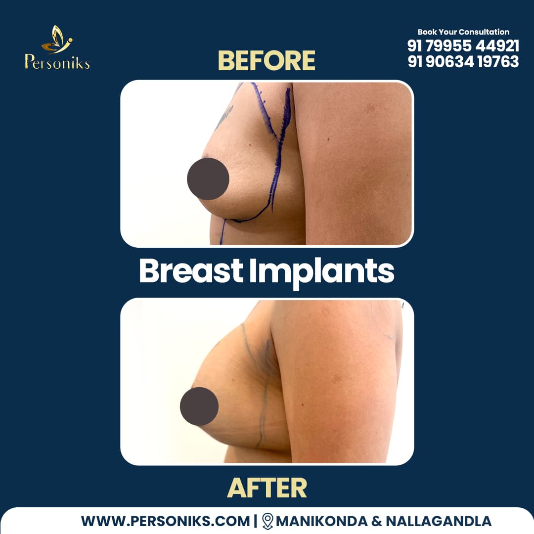 Breast Implant Surgery: Restoring Confidence and Natural Beauty