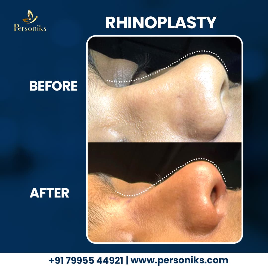 Rhinoplasty: Subtle Yet Powerful Facial Transformation