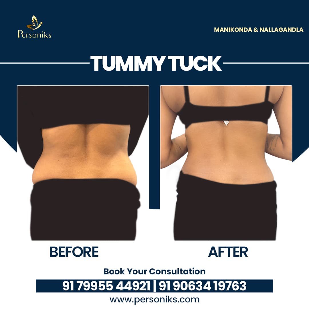 Tummy Tuck Surgery: Achieve the Flat, Toned Abdomen You Deserve
