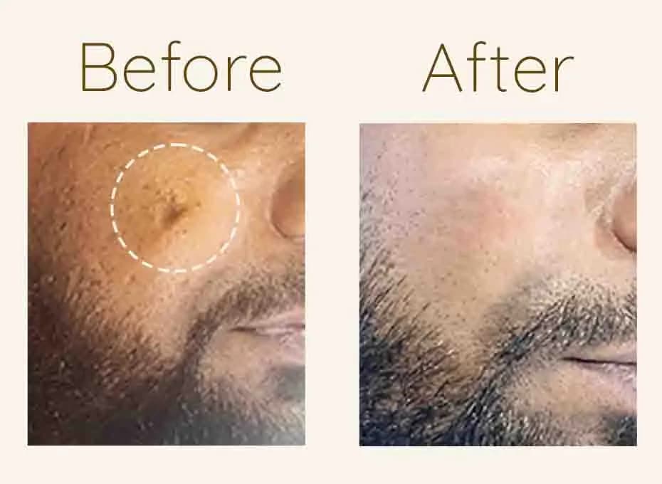 Before and After Procedure Results
