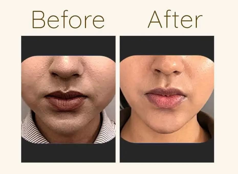 Before and After Procedure Results
