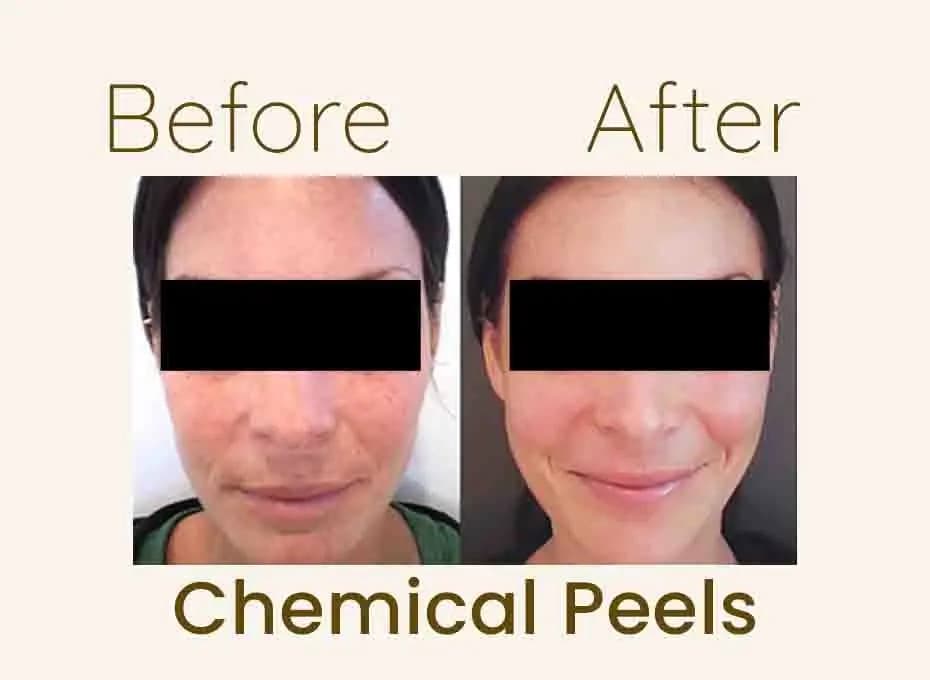 Before and After Procedure Results