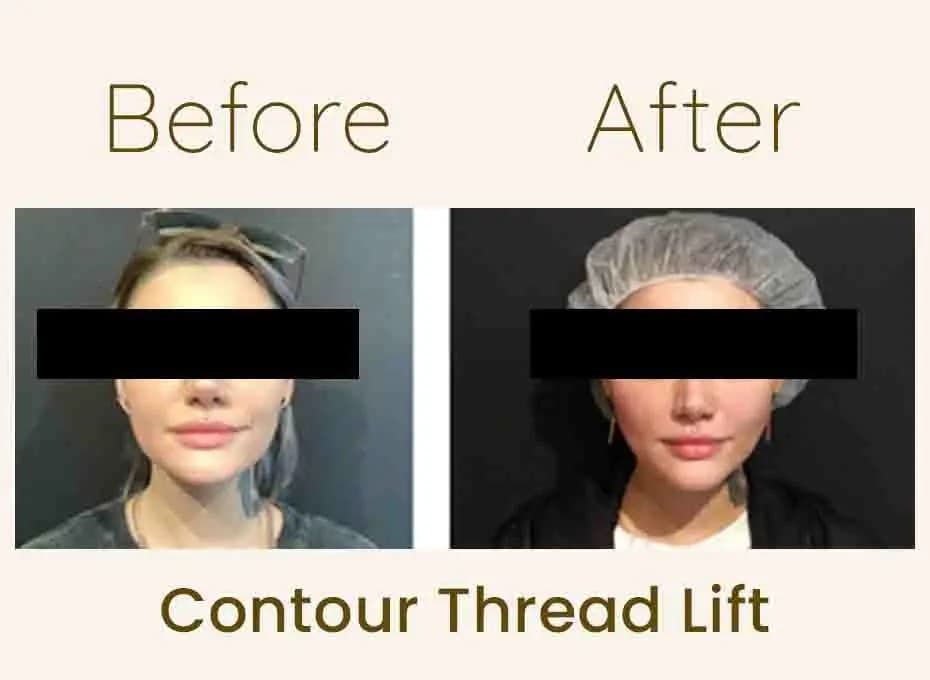 Before and After Procedure Results