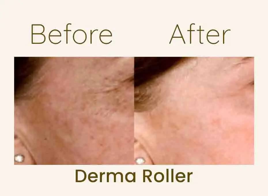 Before and After Procedure Results