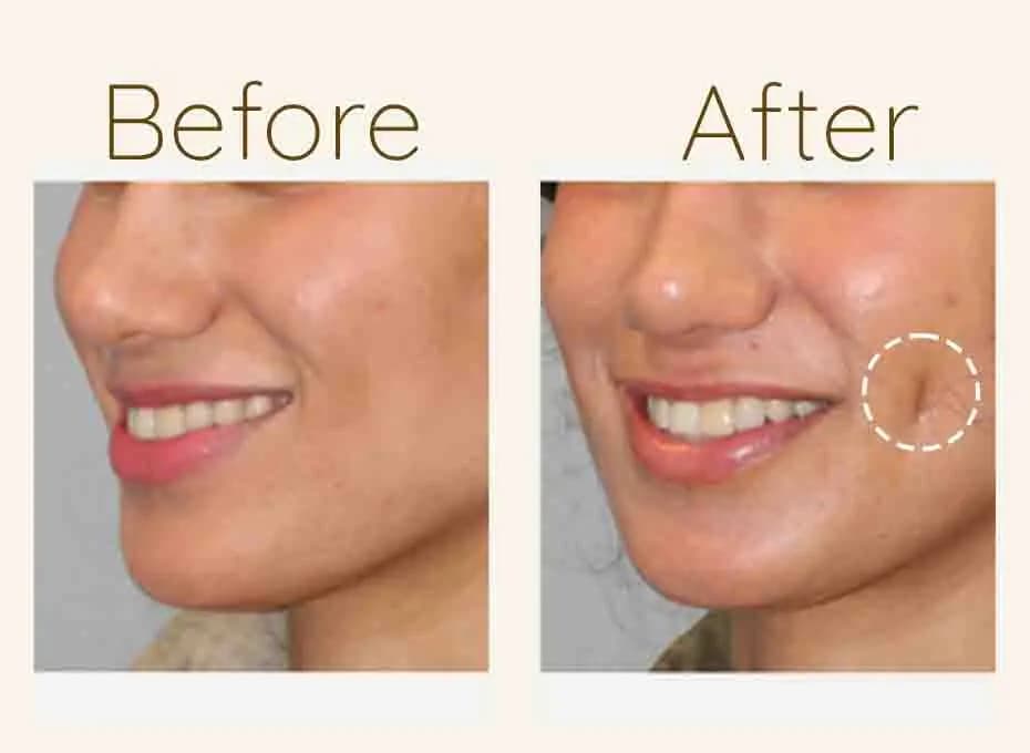 Before and After Procedure Results