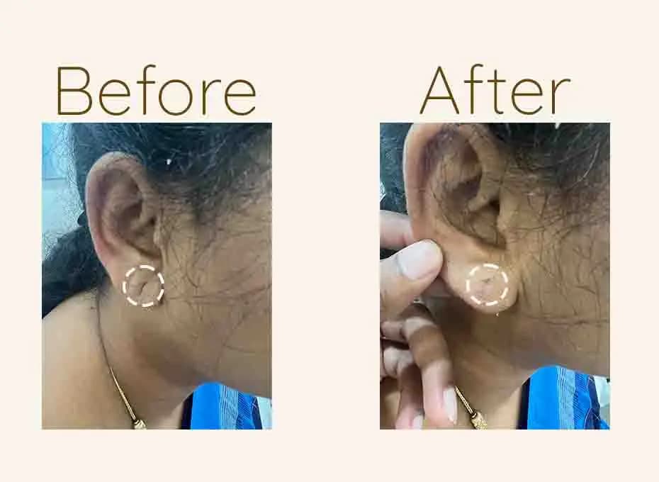 Before and After Procedure Results