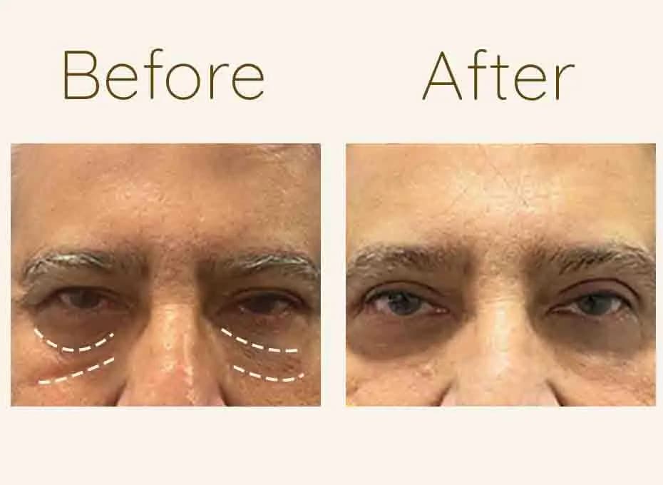 Before and After Procedure Results