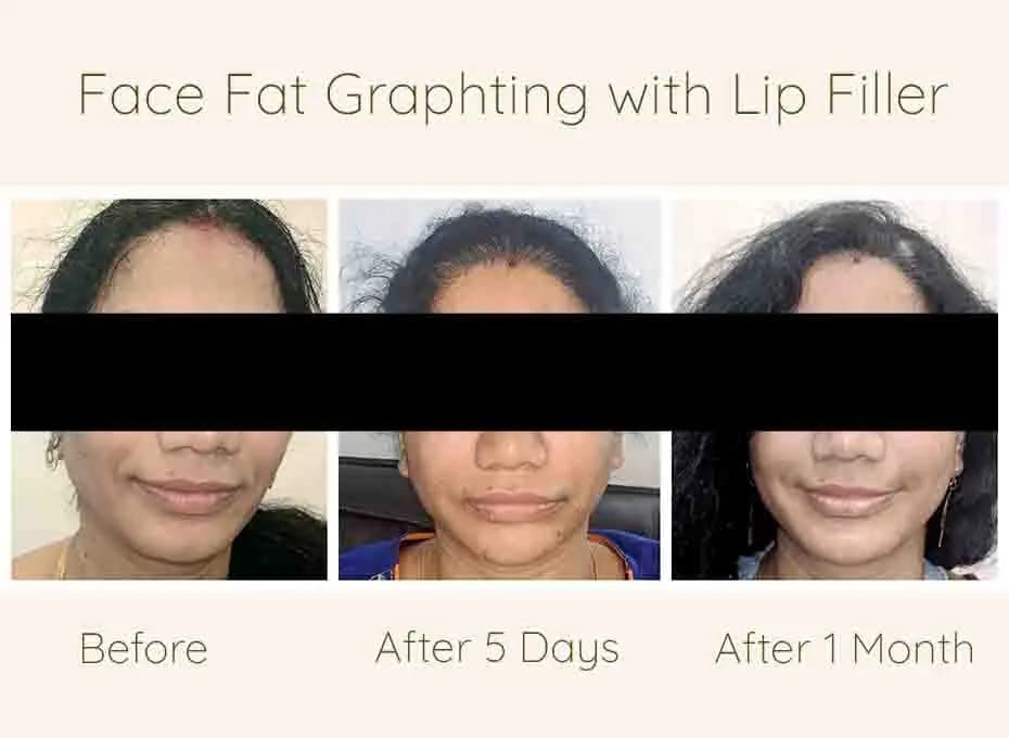 Before and After Procedure Results