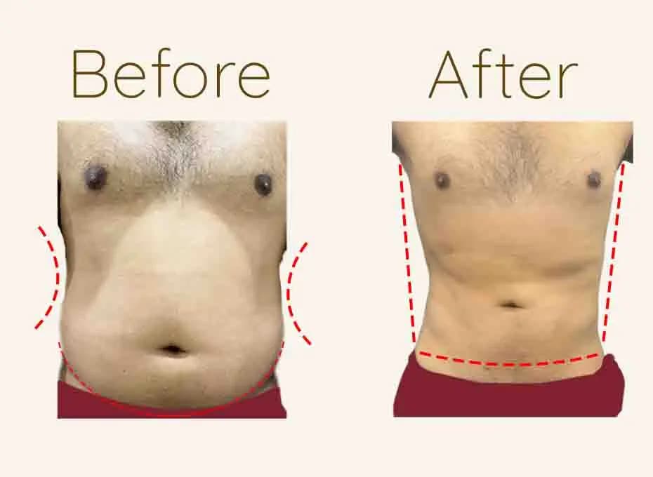 Before and After Procedure Results