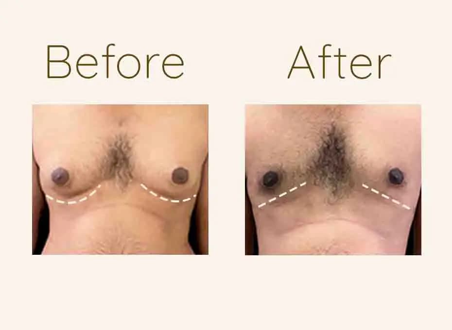 Before and After Procedure Results