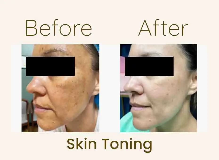Before and After Procedure Results