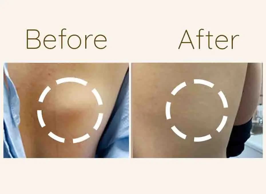 Before and After Procedure Results
