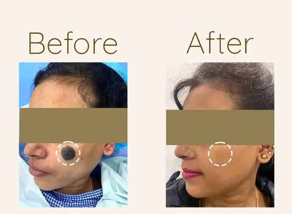 Before and After Procedure Results