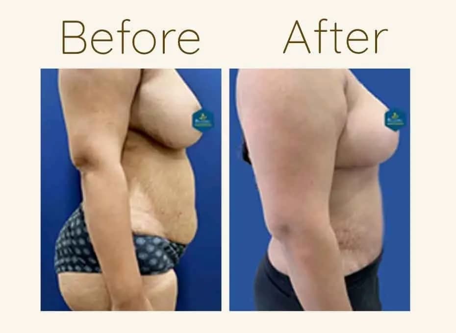 Before and After Procedure Results