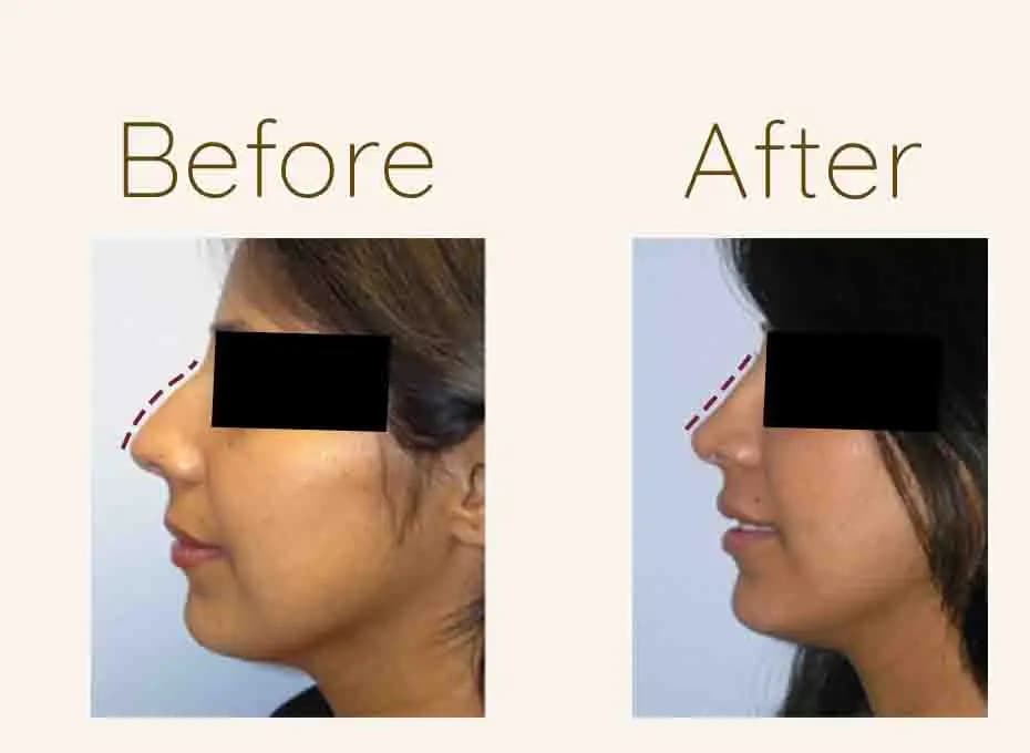 Before and After Procedure Results