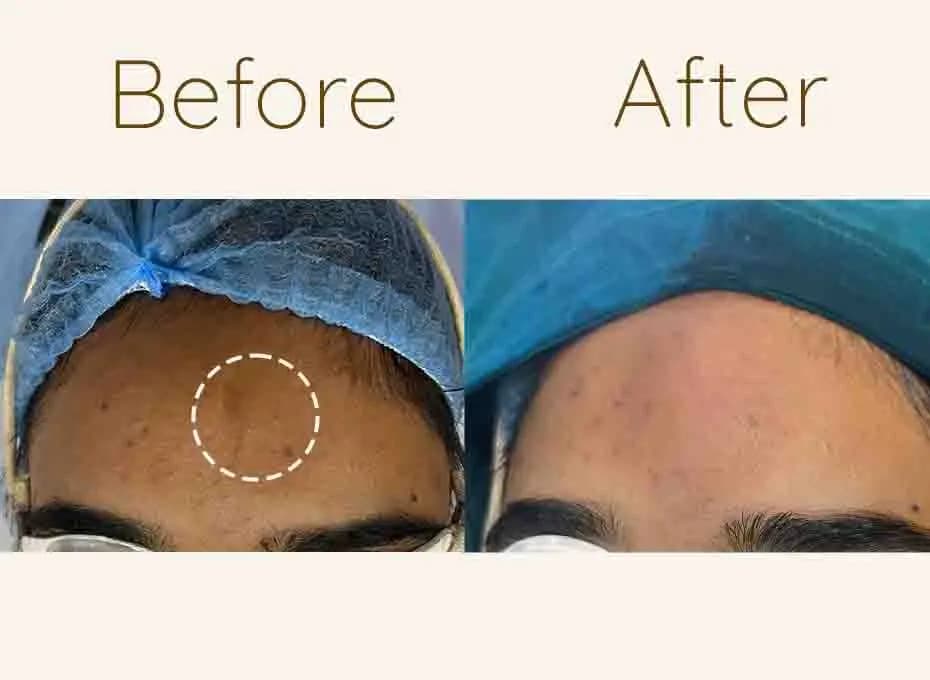 Before and After Procedure Results