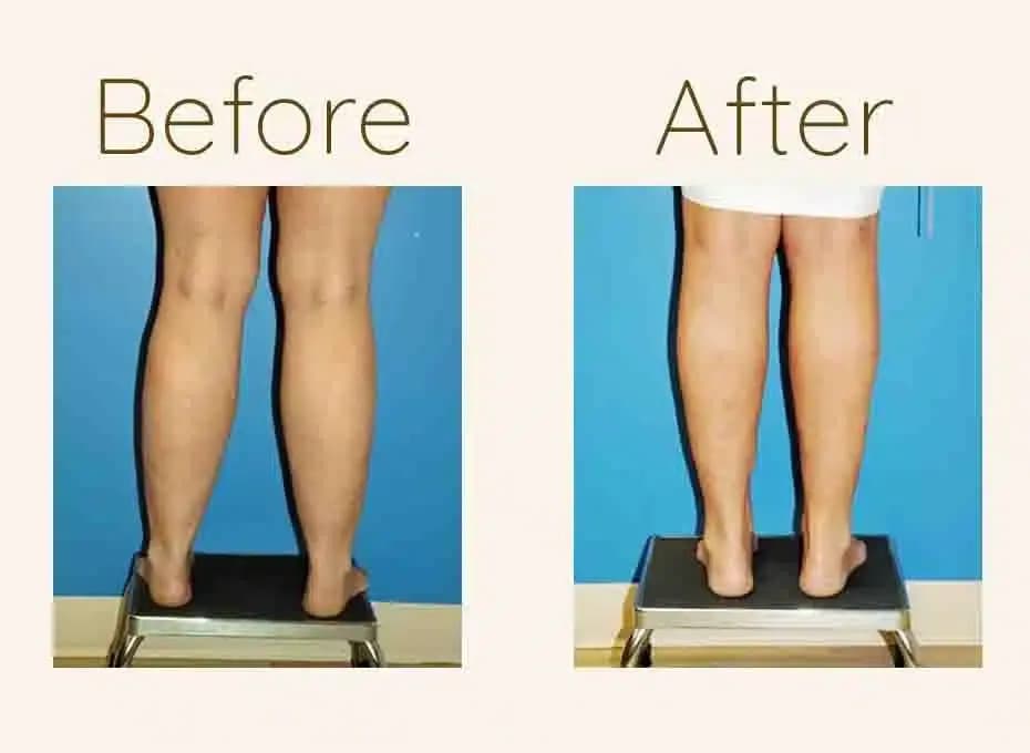 Before and After Procedure Results