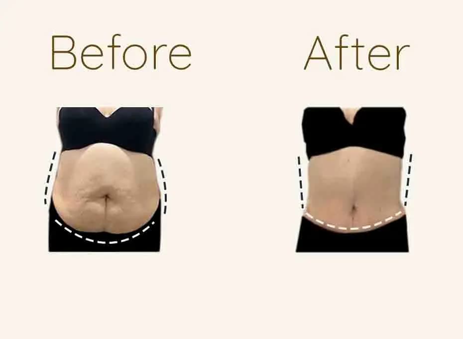 Before and After Procedure Results