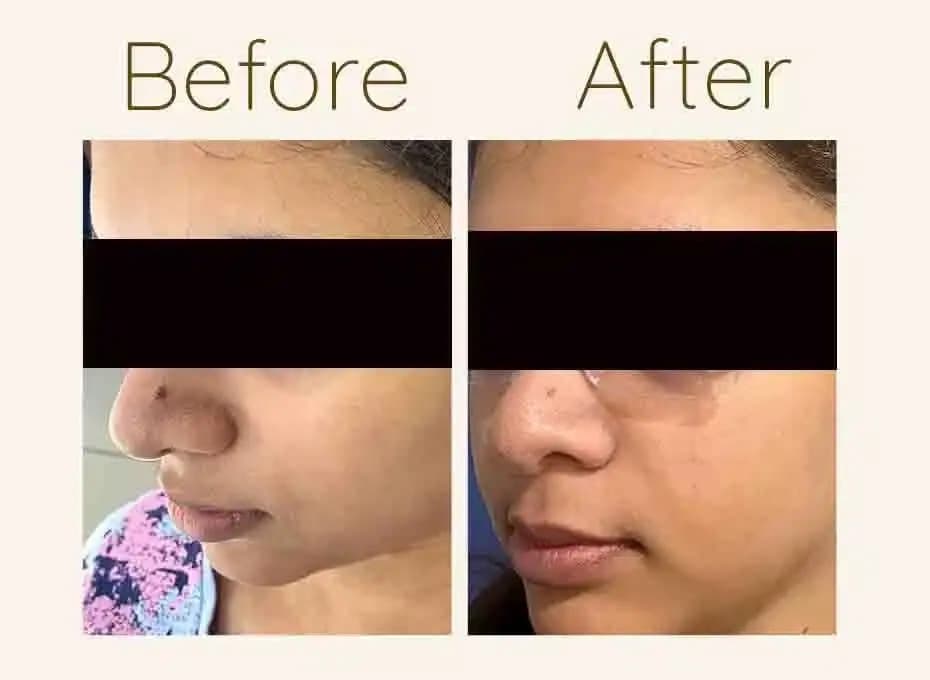 Before and After Procedure Results