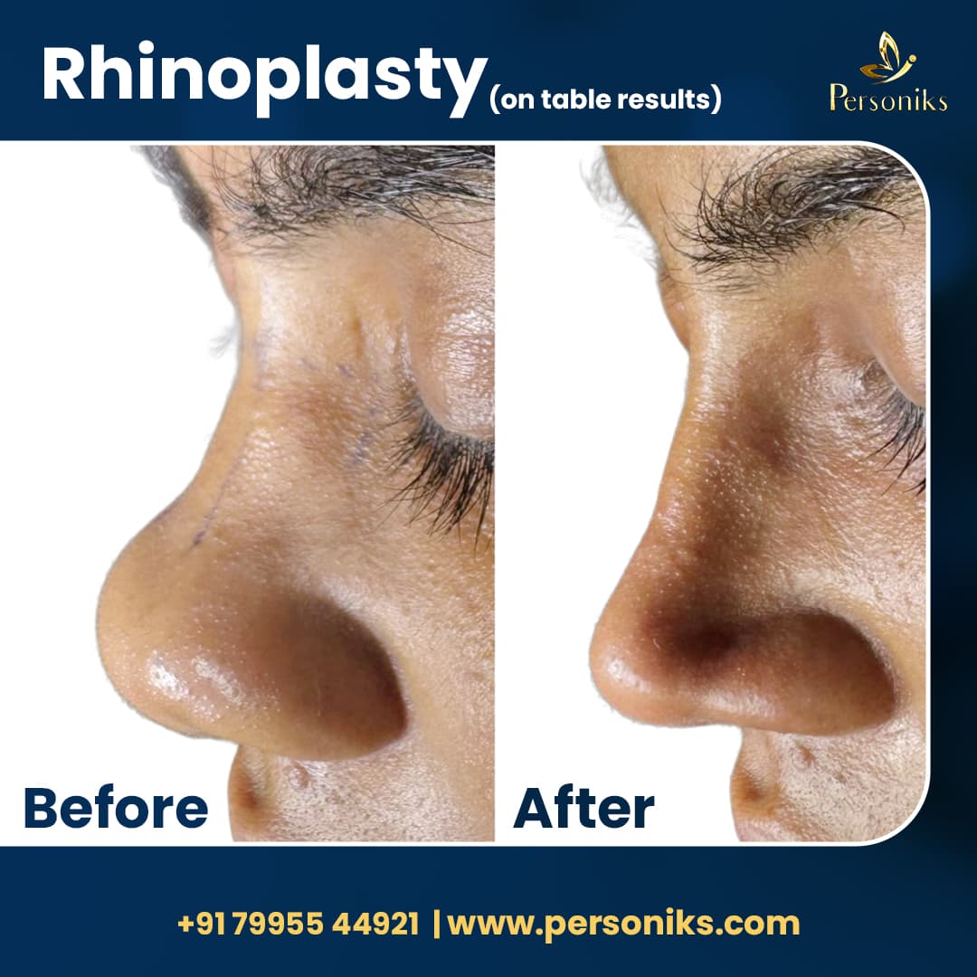 Before and After Results 1