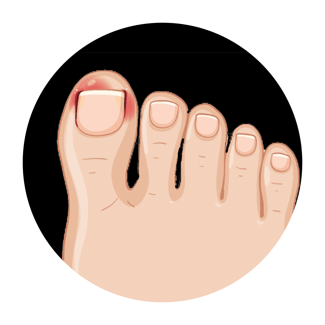 Ingrown Toenail