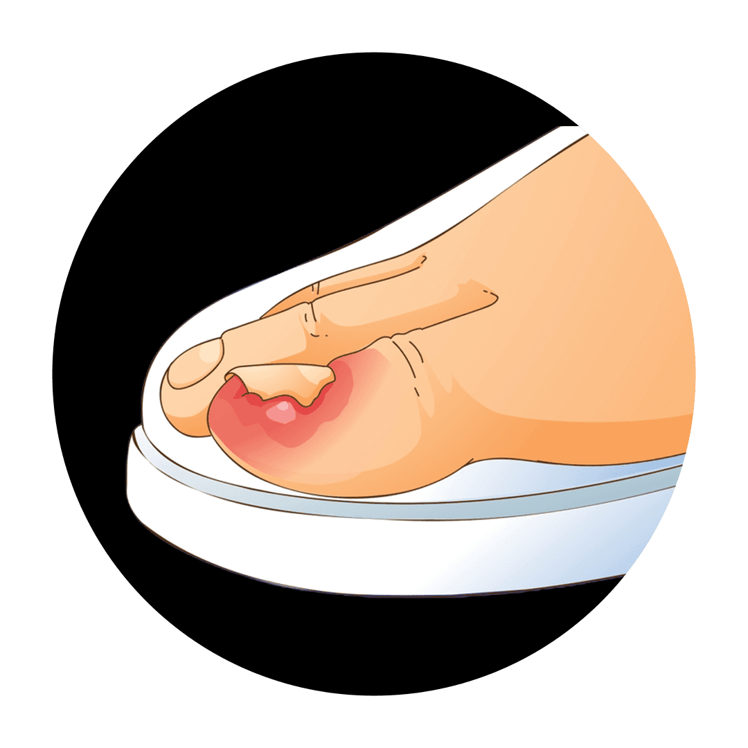 Nail Injuries & Infections