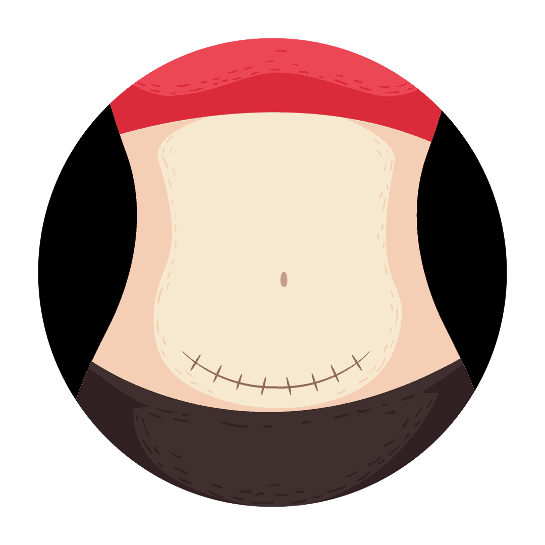 Scar / Keloid Treatment