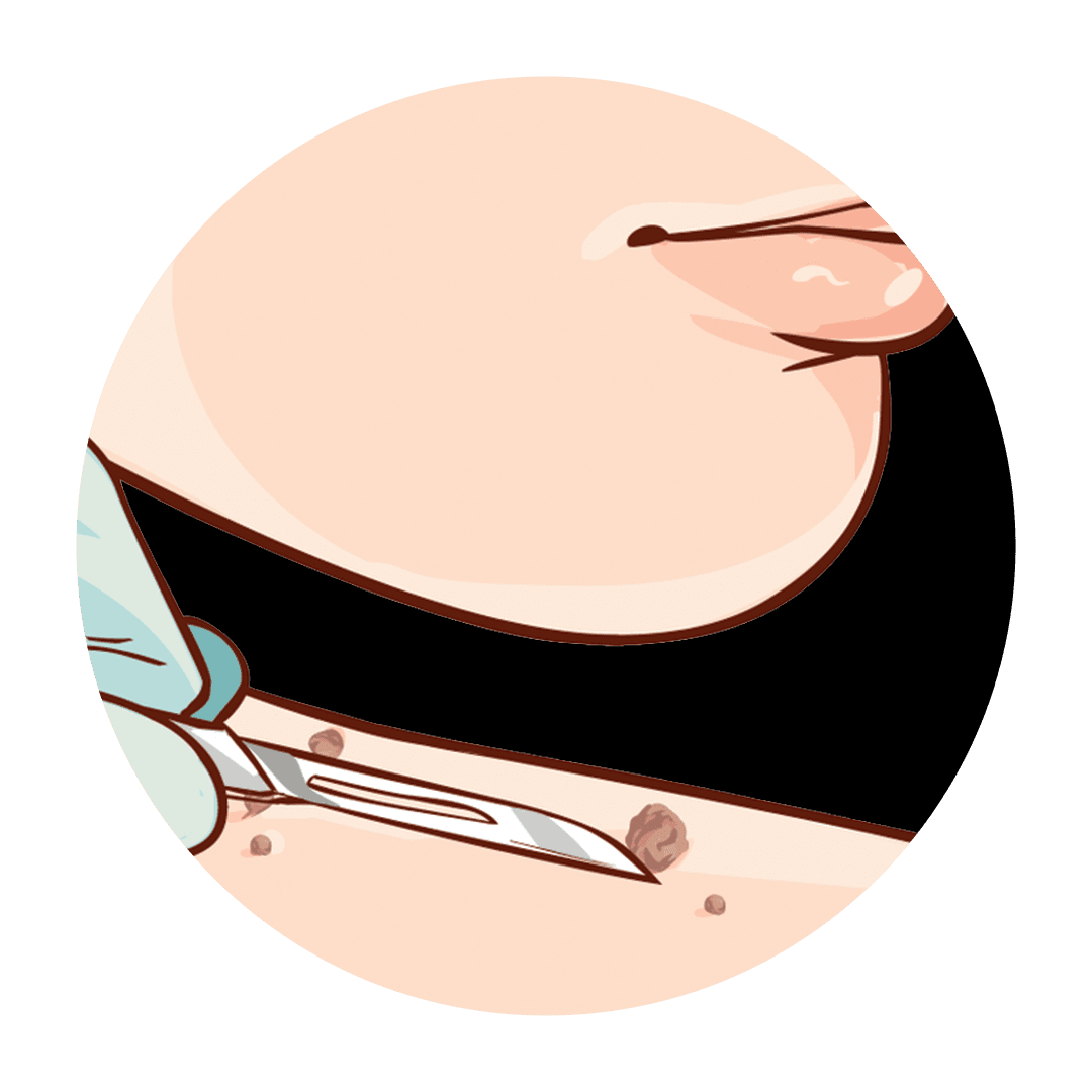 Skin Tags Removal