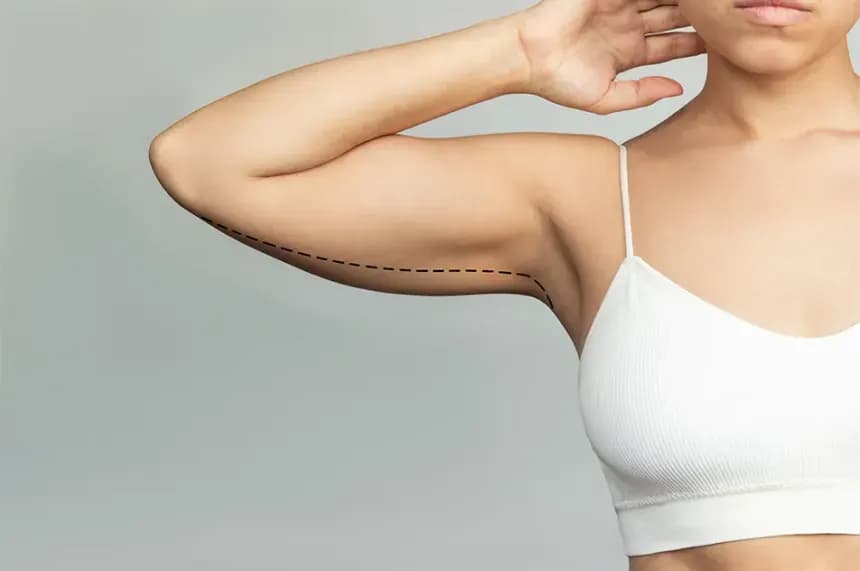 Arm Lift (Brachioplasty) Surgery in Hyderabad | Cost, Scars & Recovery Explained