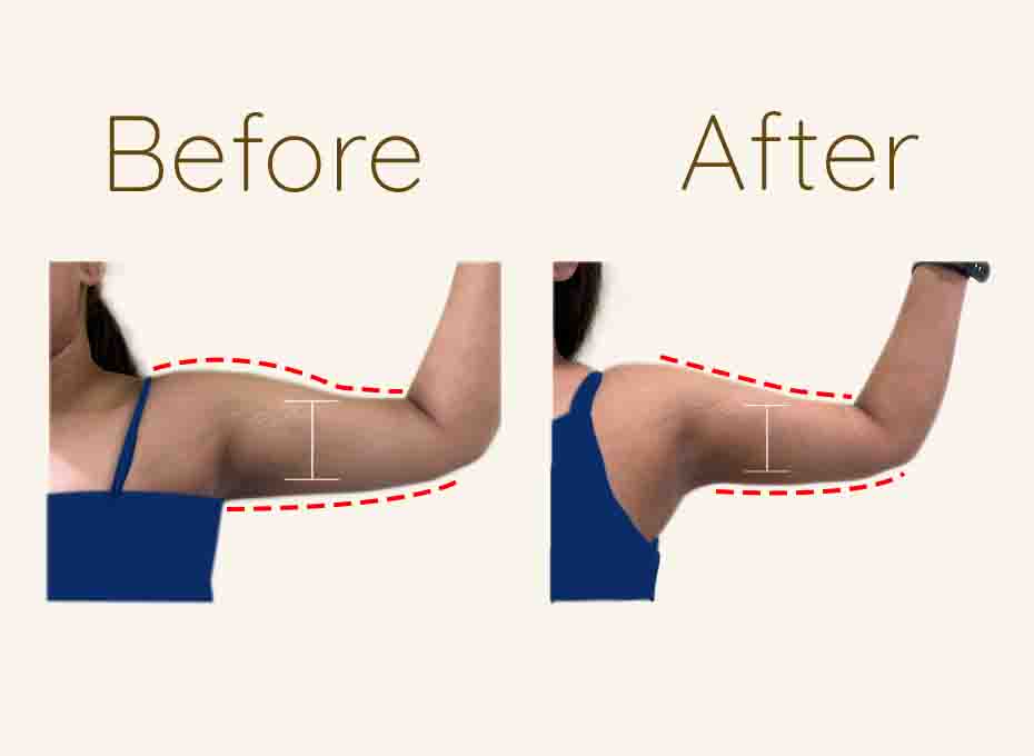 Arm Liposuction in hyderabad