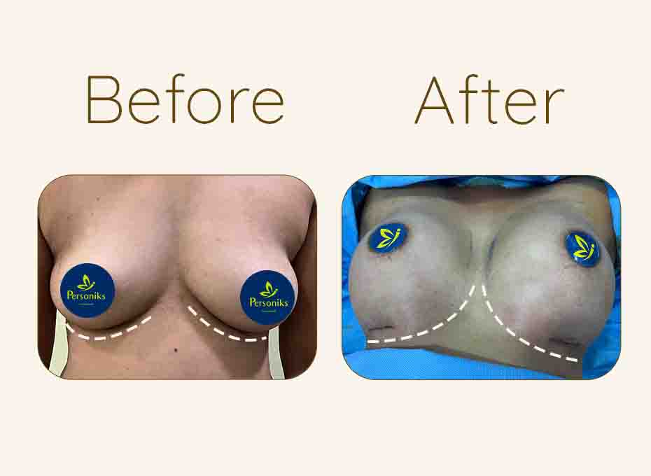 Breast Augmentation Website Icon Before and After 1