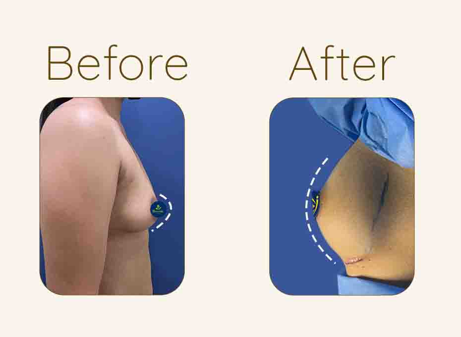 Breast Lift – Indian Association Of Aesthetic Plastic Surgeons