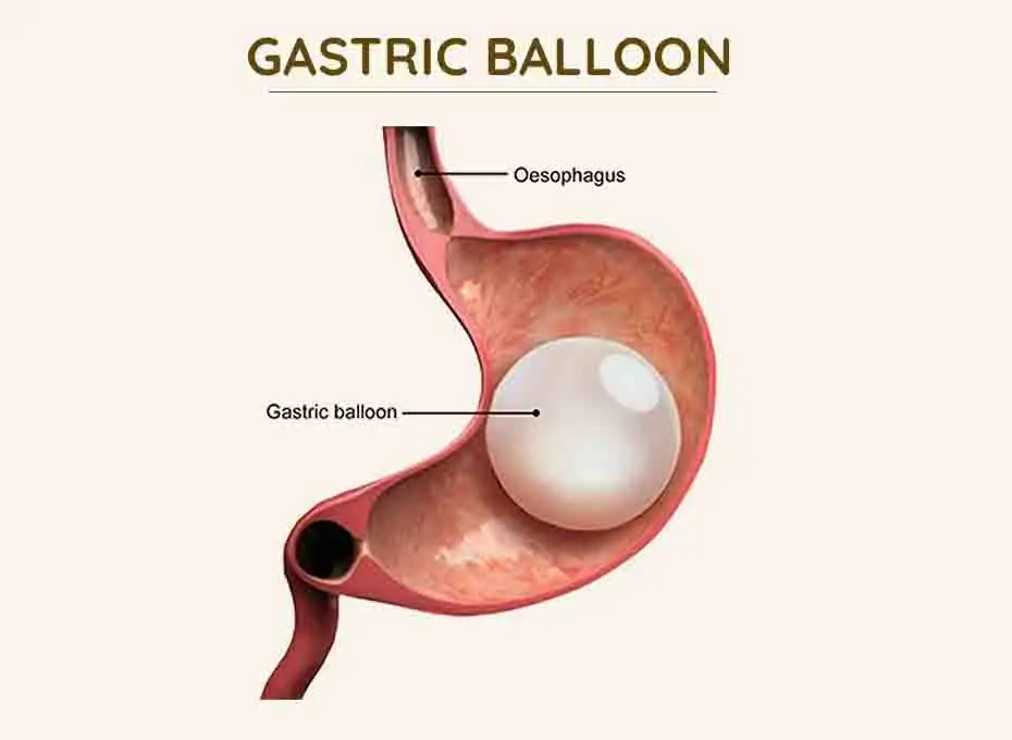 Gastric Balloon