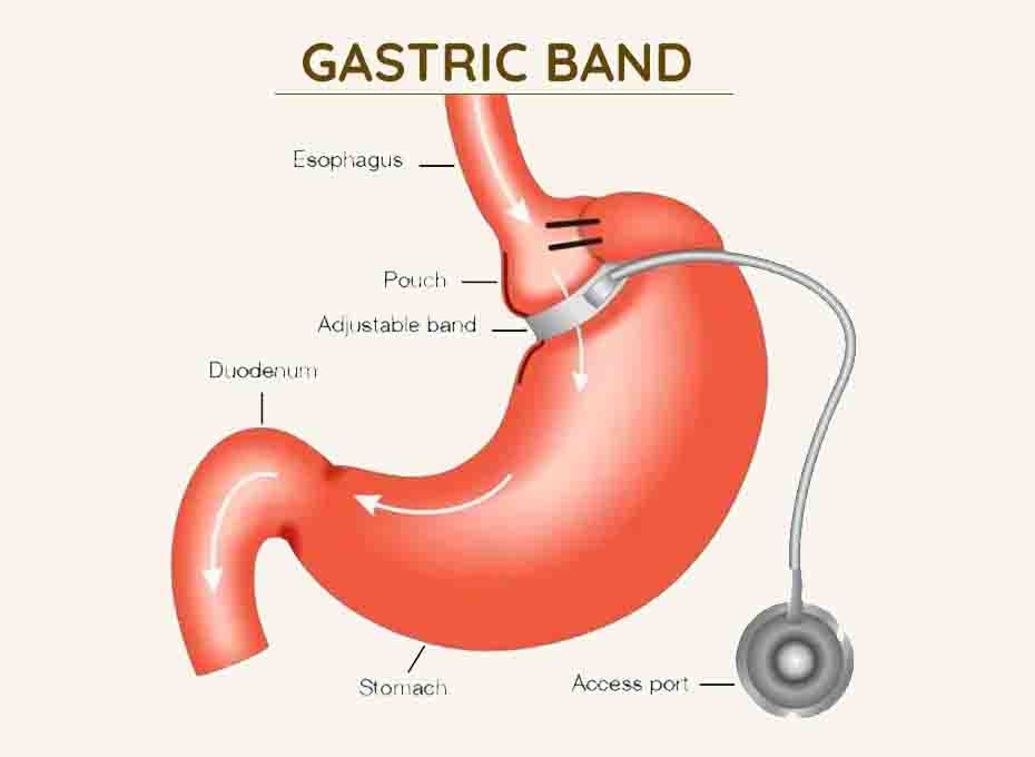 Gastric band