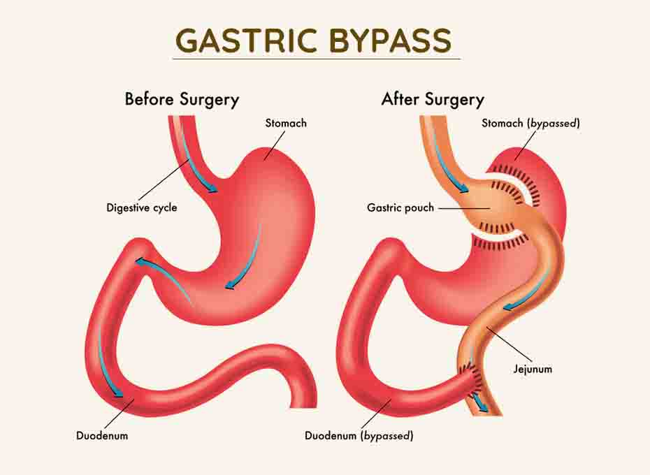 Gastric Bypass